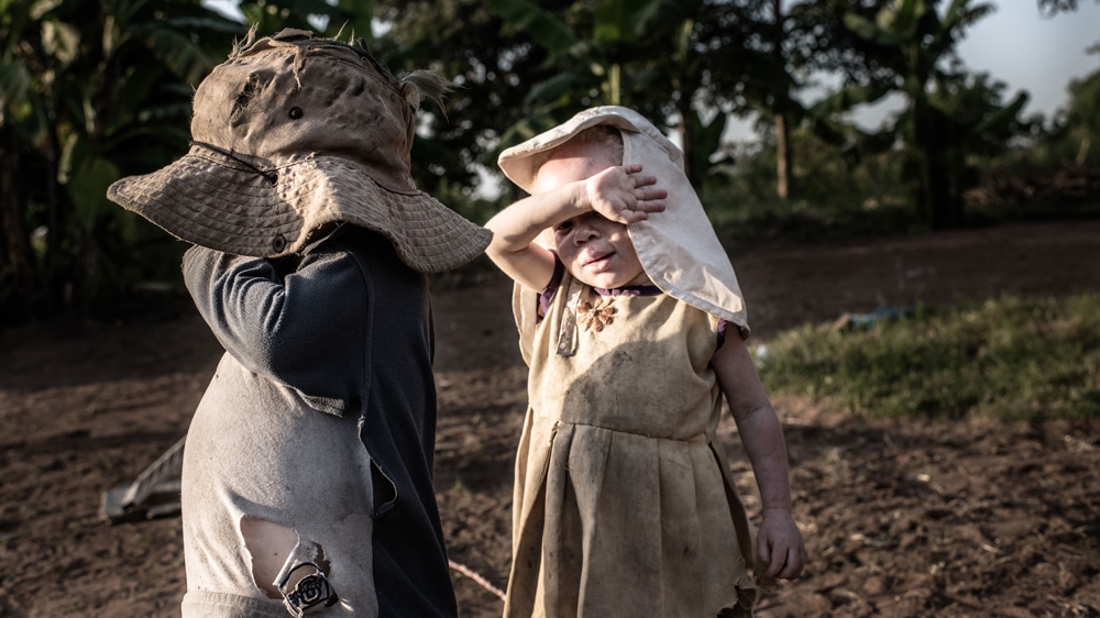 Albinism affects their vision and when the sun is bright it's hard for the children to see properly [Fredrik Lerneryd/Al Jazeera]