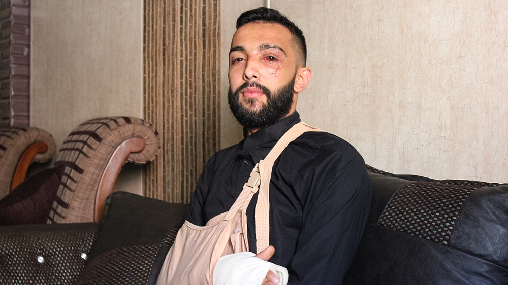 Doctors told Hussein Haydar his eye injuries will recover, but his facial scars will remain