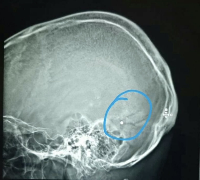 Beirut explosion: A metal pellet lodged near the back of Dr. Elie Saliba’s head (Courtesy Fred Bteich)