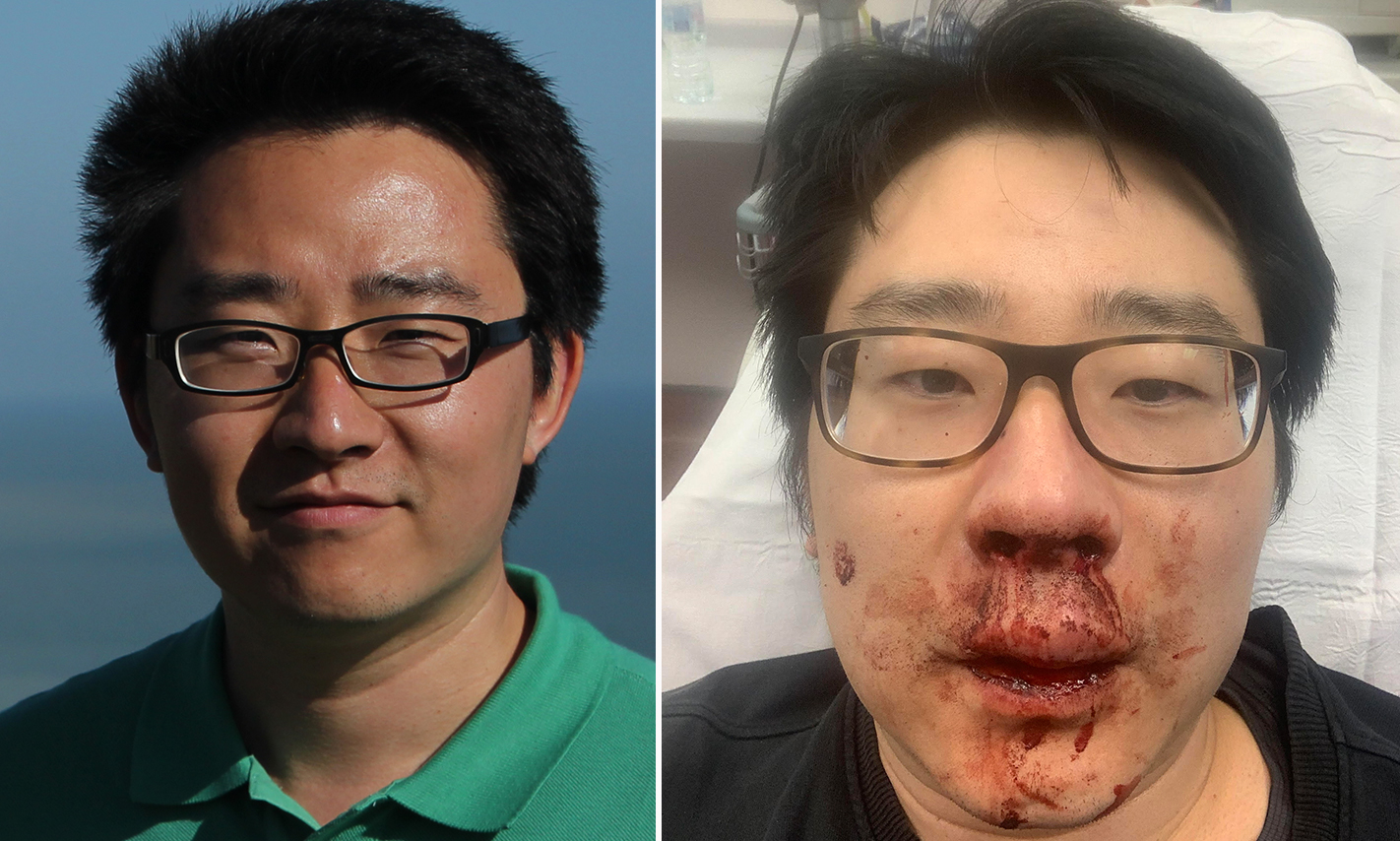 Peng Wang was attacked last month as he was jogging near his house [Courtesy: Peng Wang]