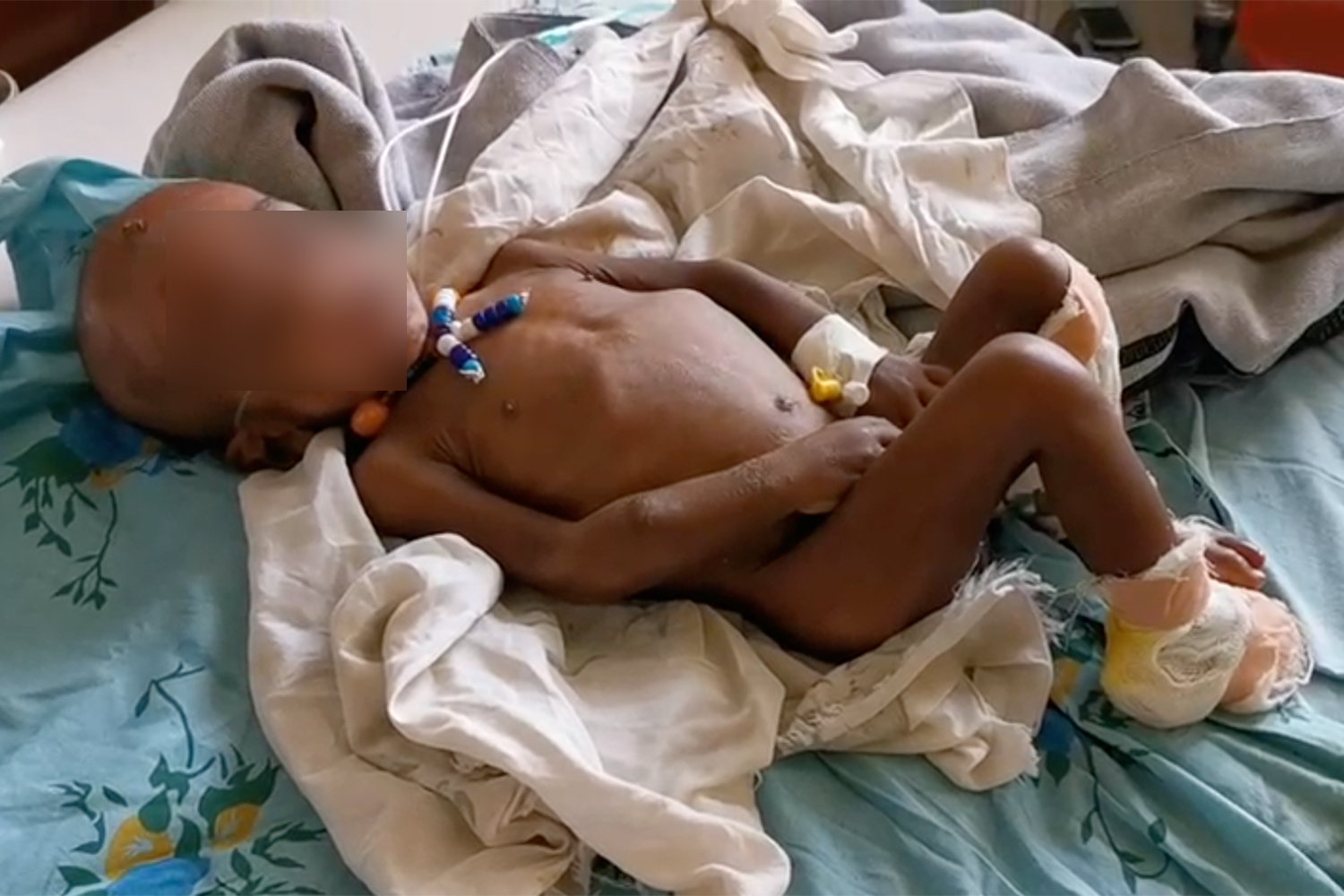 Gebreanannya Tesfay at Ayder hospital [Courtesy Al Jazeera]