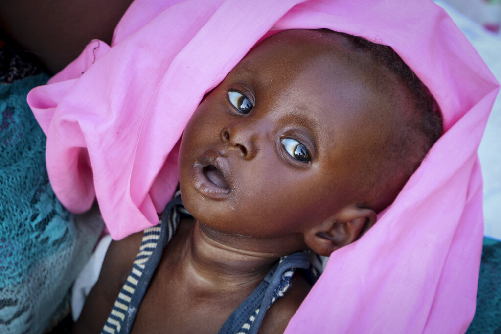 Malnourished five-month old Tiere Pascol, whose mother can't afford food and has trouble breastfeeding, lies in his mother's arms at a feeding center in Al Sabah Children's Hospital in Juba, South Sudan
