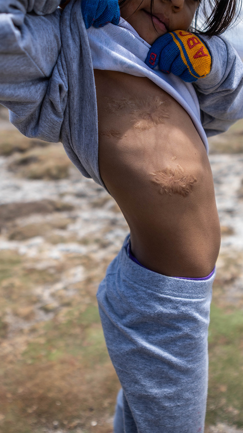 A young girl lifts her grey sweatshirt to reveal knots of scar tissue where her lung surgery took place.