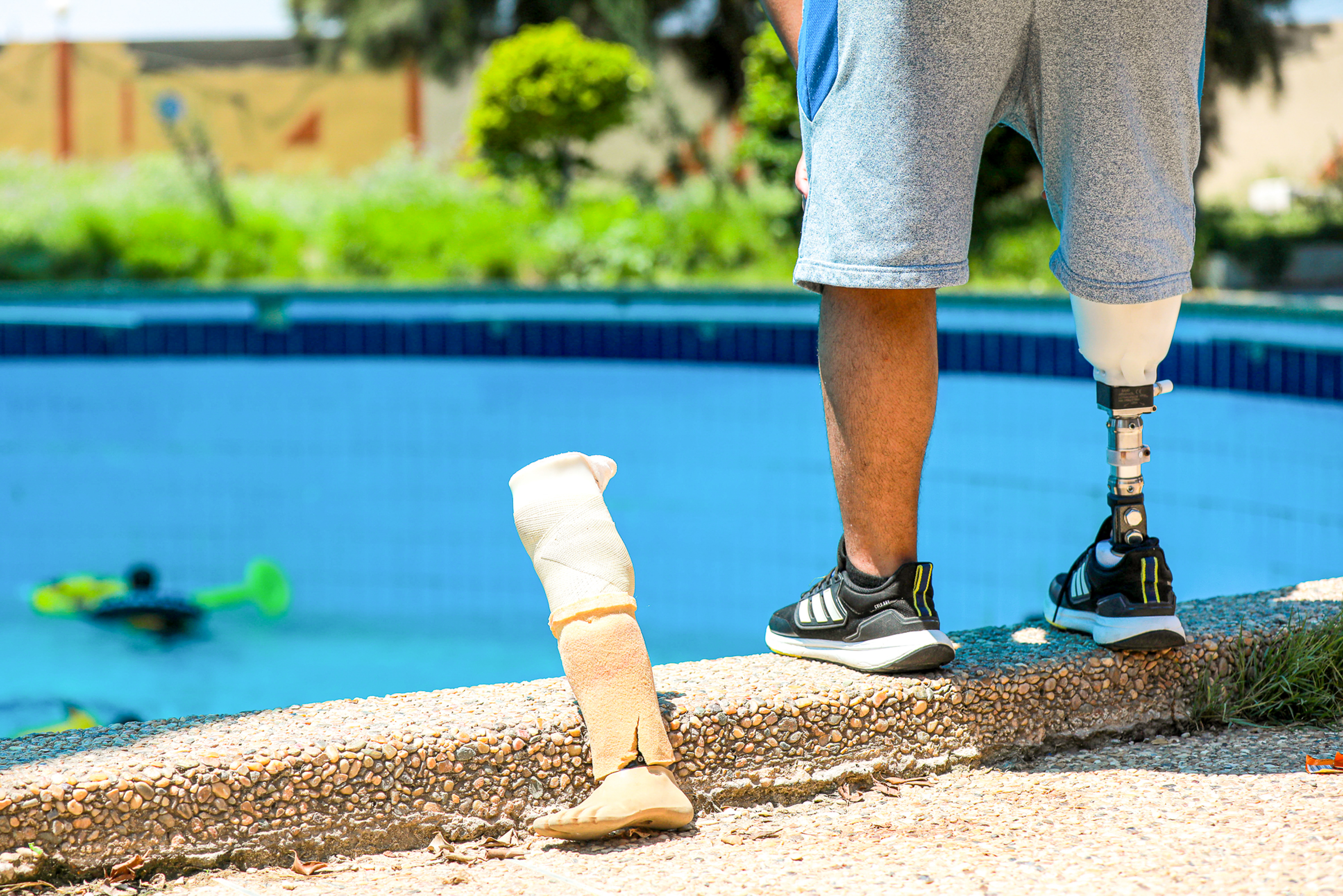 child amputees in Gaza