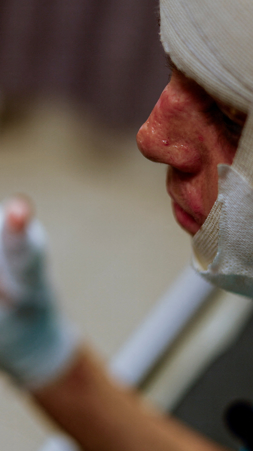 A Palestinian man with a bandaged head and hands sits in a hospital in Rafah.