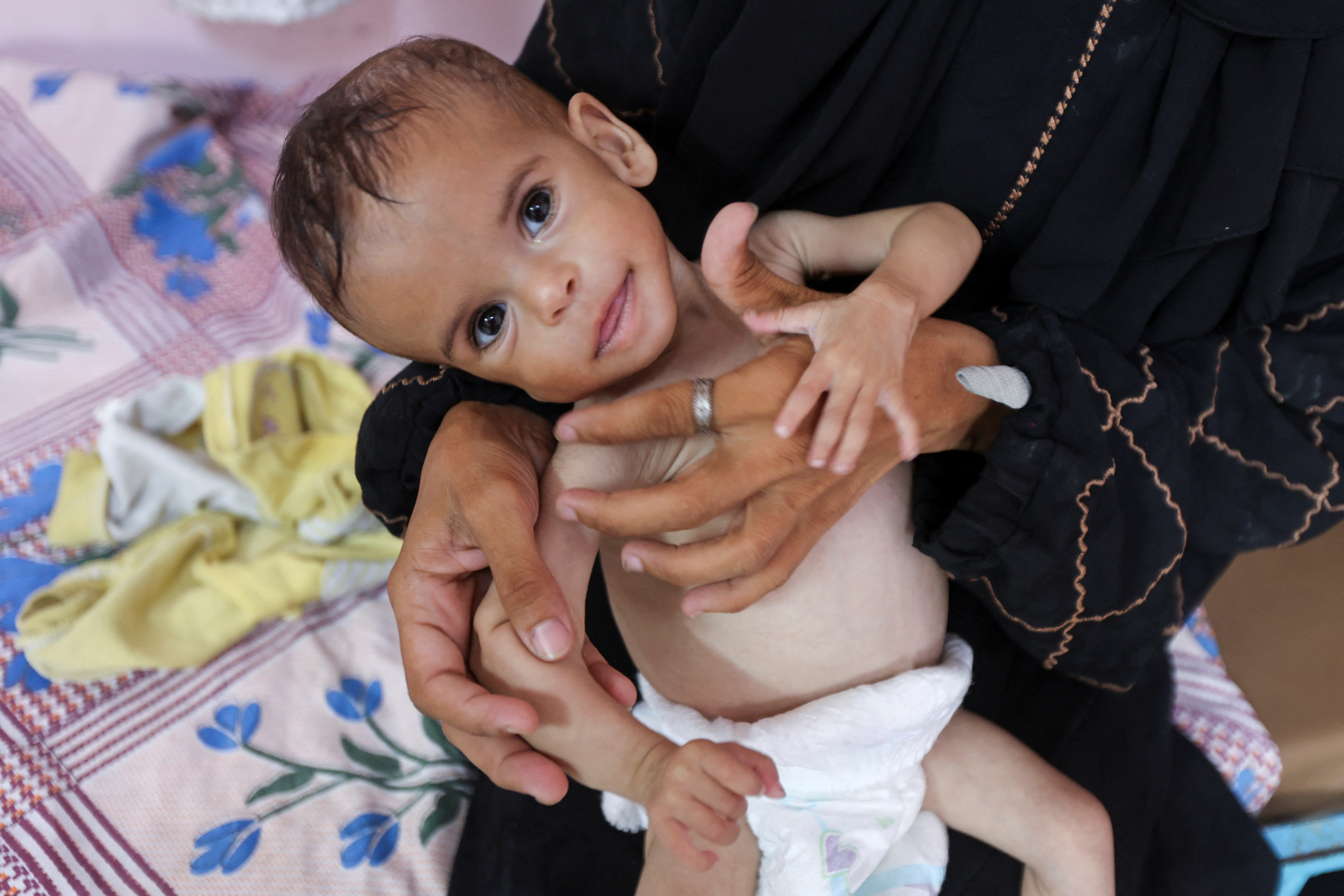 Seela Barbakh, an 11-month-old Palestinian girl who is malnourished, according to medics, is held by her mother, Najah, at Nasser Hospital in Khan Younis, in the southern Gaza Strip, July 23, 2025. REUTERS/Ramadan Abed