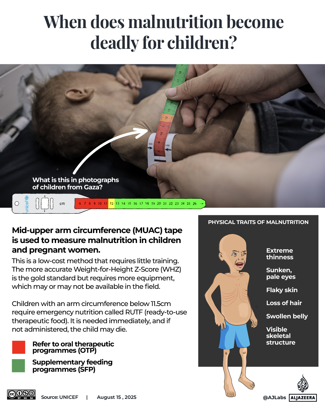 INTERACTIVE - Gaza malnutrition in children