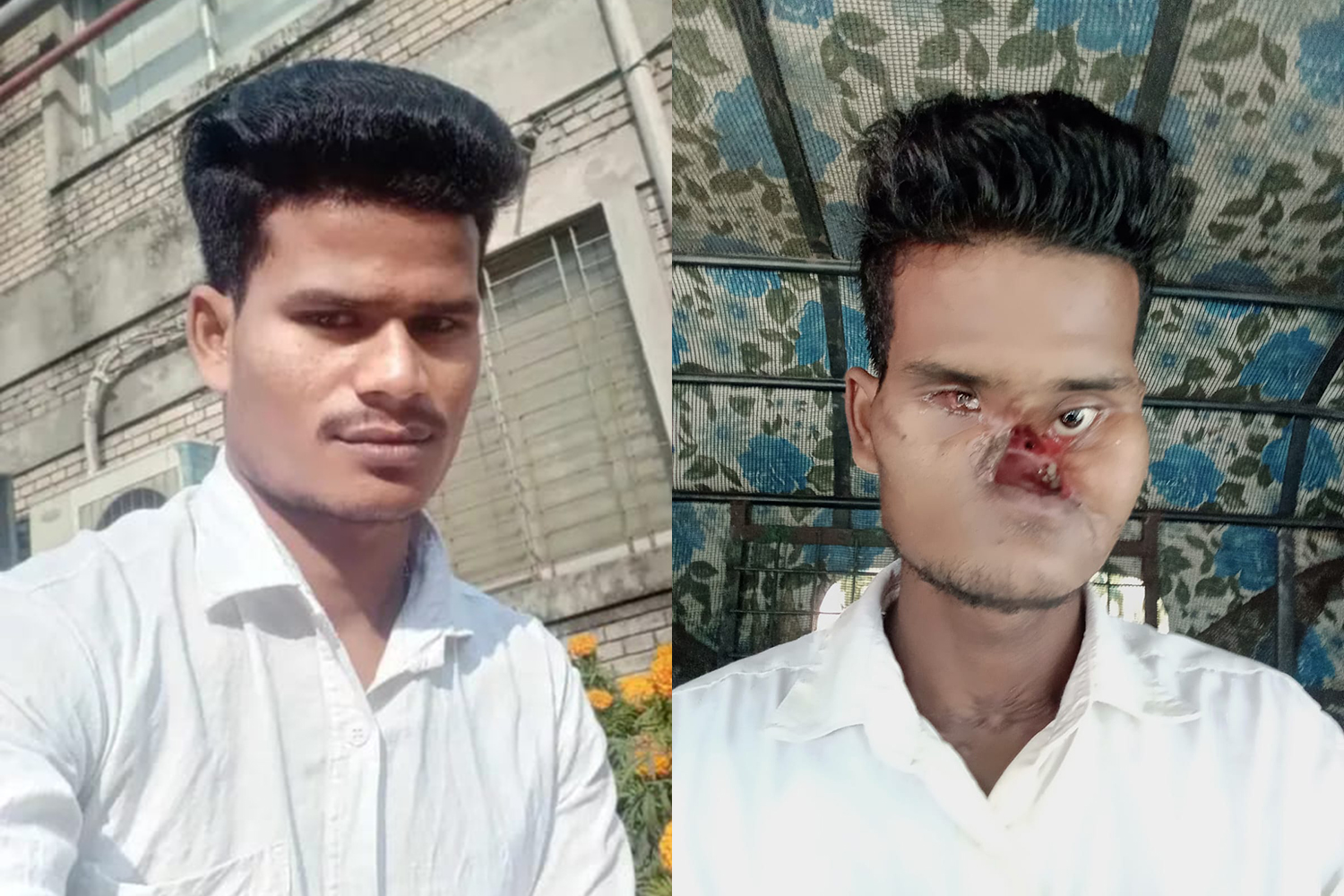 Barman lost almost his entire face after he was shot by the police [Courtesy of Khokon Chandra Barman]