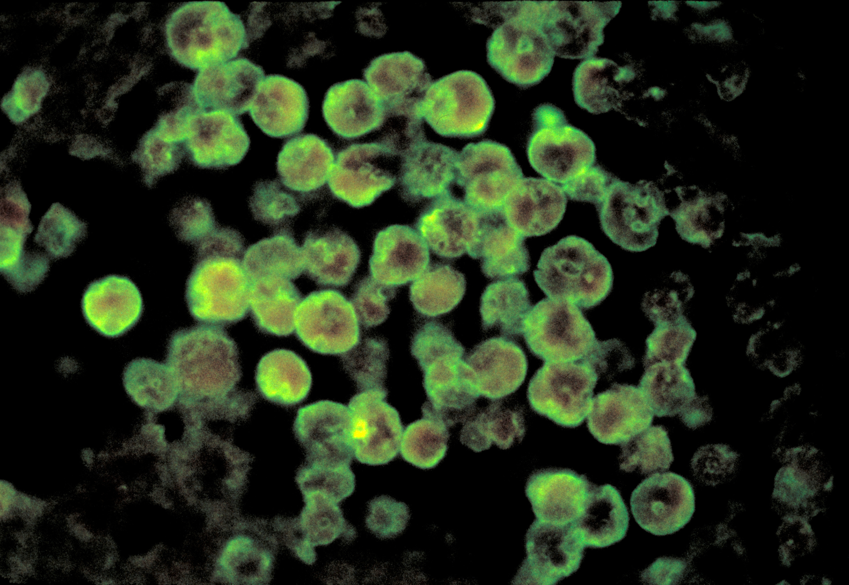 A handout photomicrograph provided by the Centers for Disease Control and Prevention (CDC) depicts the characteristics associated with a case of primary amebic meningoencephalitis, a rare brain infection due to Naegleria fowleri parasites, a brain-eating amoeba.