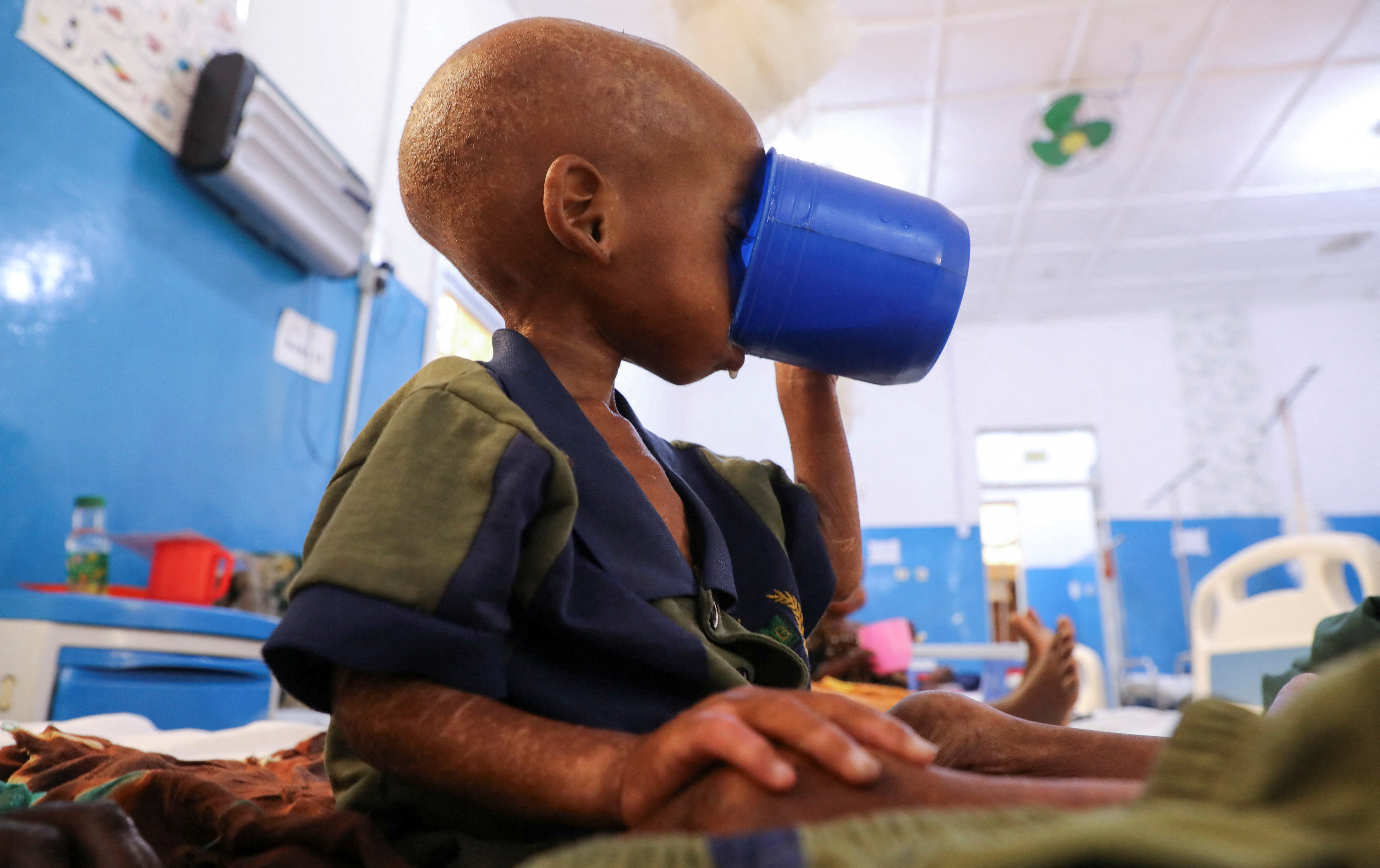 A malnourished Somali child drinks milk.