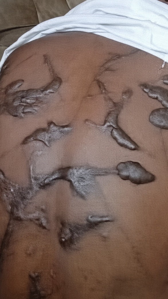 Haruna Hamza displays scars on his back from an alleged assault in Adamawa State, Nigeria